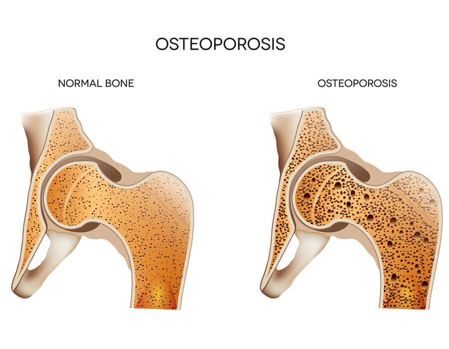 Osteoporosis