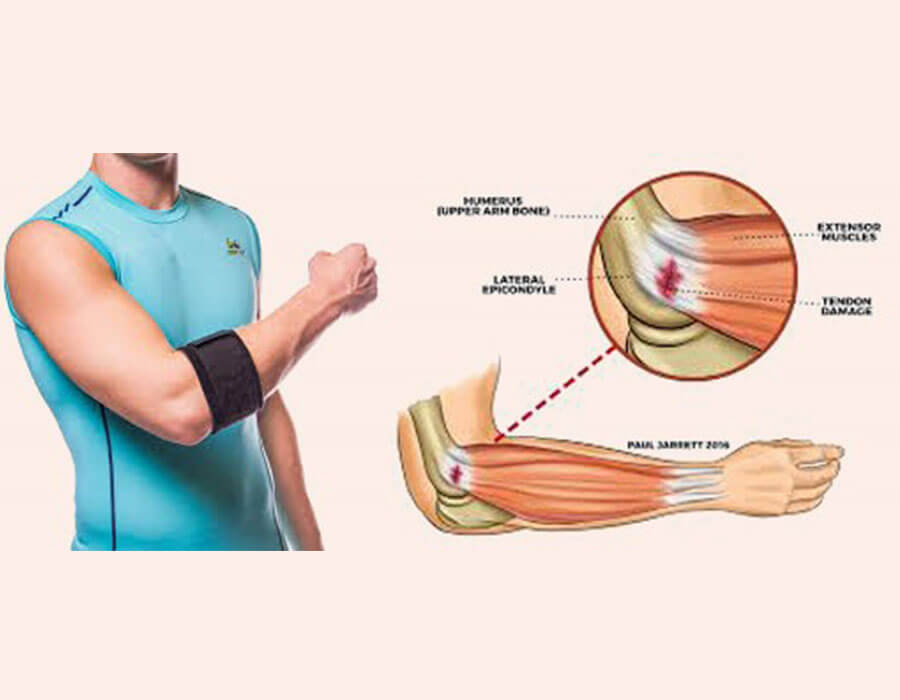 Tennis Elbow