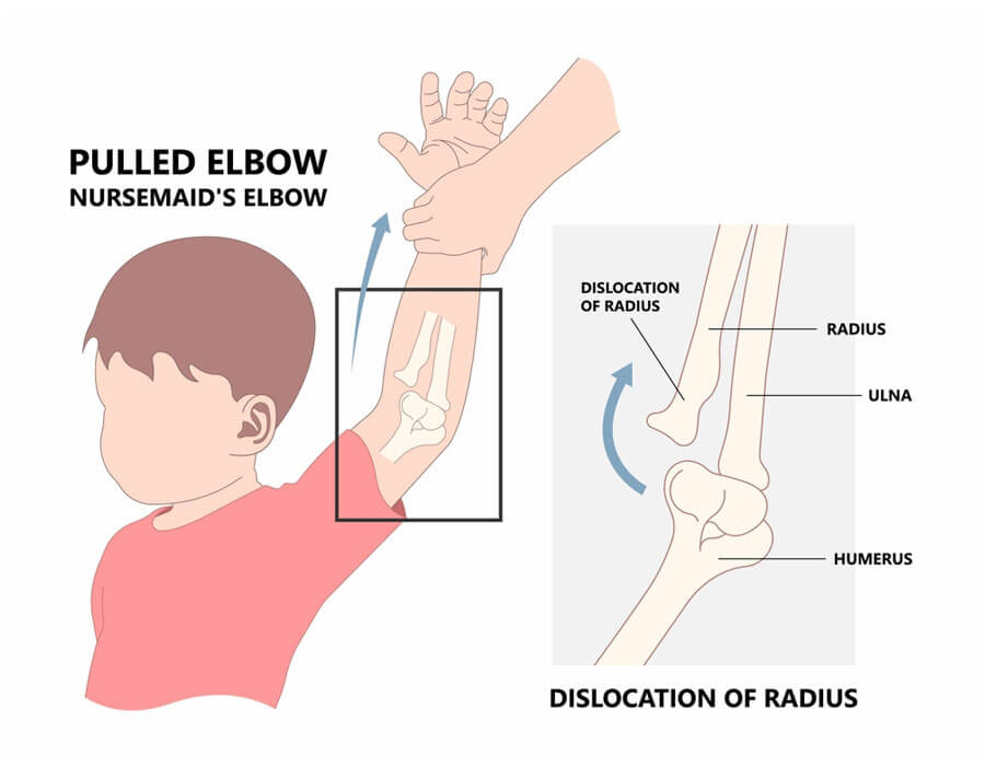 Elbow-Pull-in-children