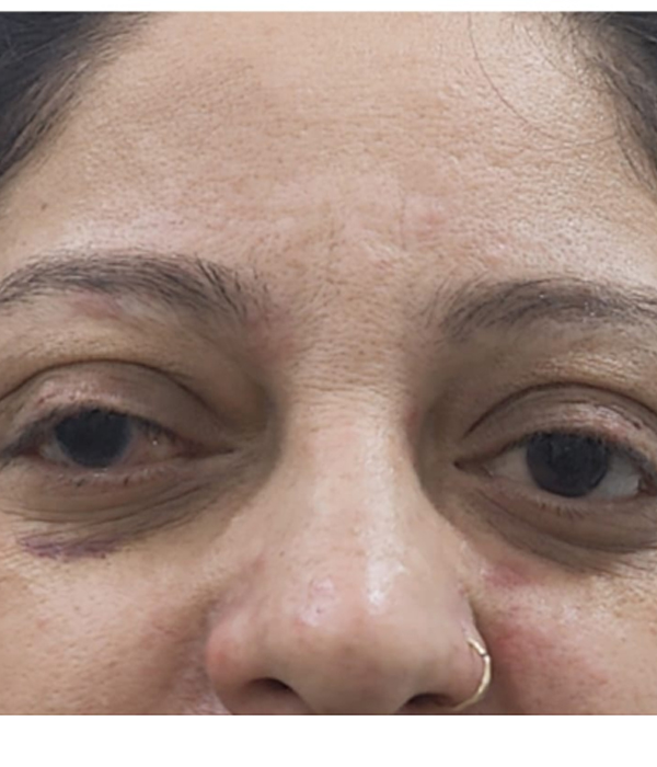 After Corneal Tatooing