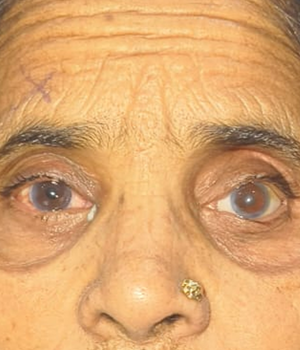 After Ocular Custom Fit Prosthesis (CFP)