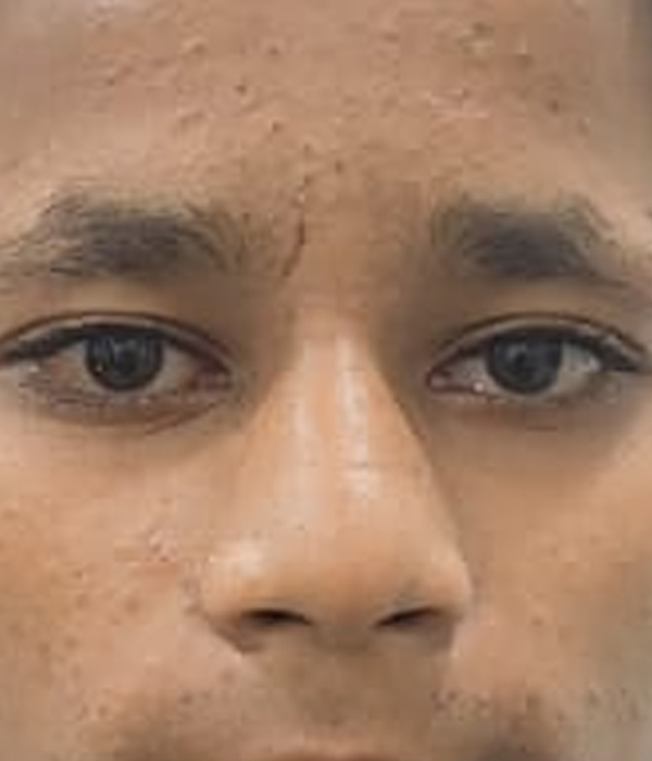After Squint Surgery