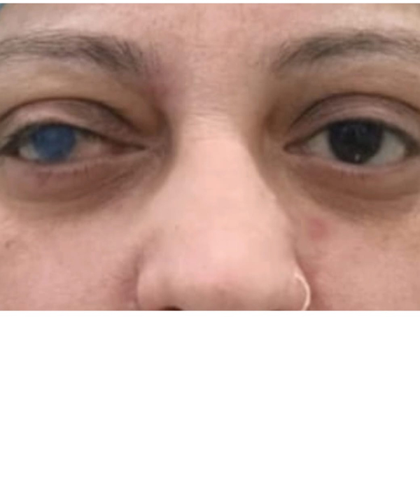 Before Corneal Tatooing
