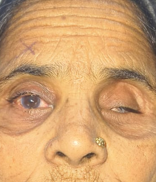 Before Ocular Custom Fit Prosthesis (CFP)