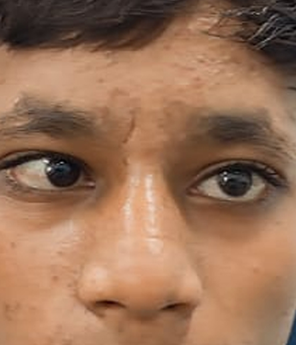 Before Squint Surgery